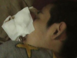 Penderita Tumor Hidung Kembali Ditangani RSUD Dr. Soetomo