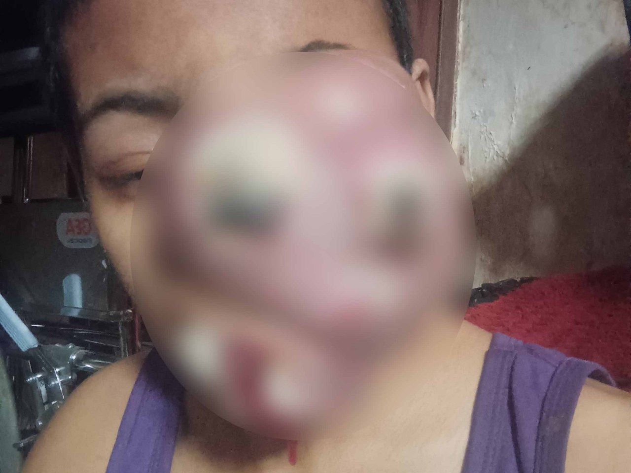 Kondisi Lovelyta Anisa Pudianto, wanita 32 tahun warga Pacar Keling, Surabaya, pasca operasi pengangkatan kanker hidung.