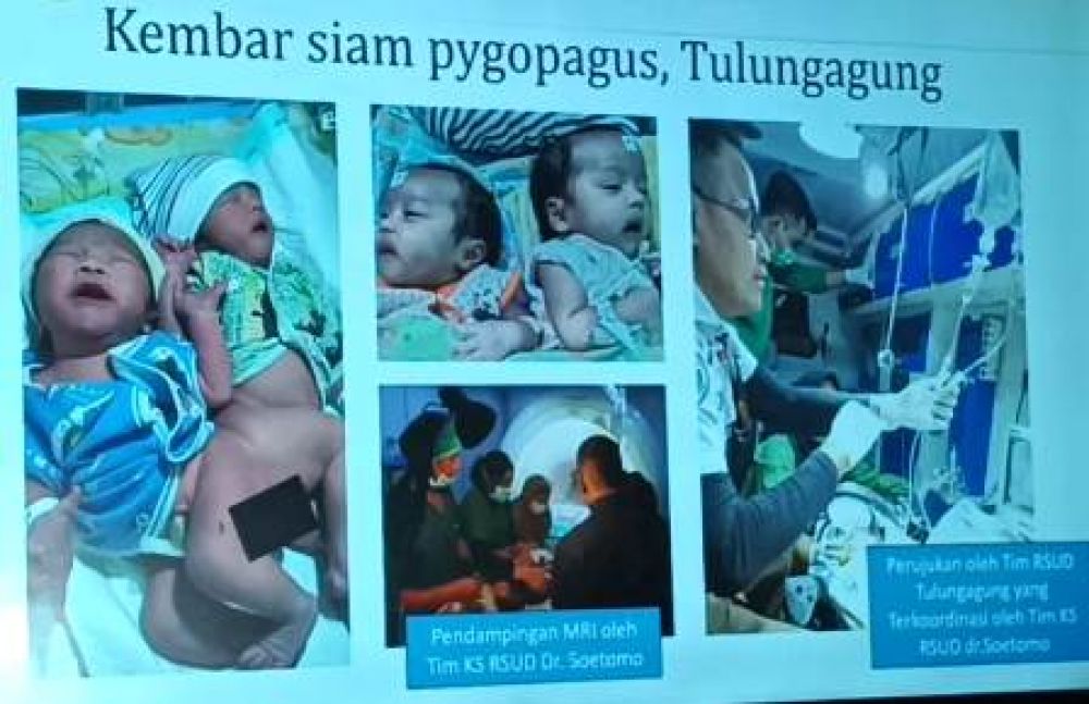 Bayi Kembar Tulungagung Berhasil Dipisahkan