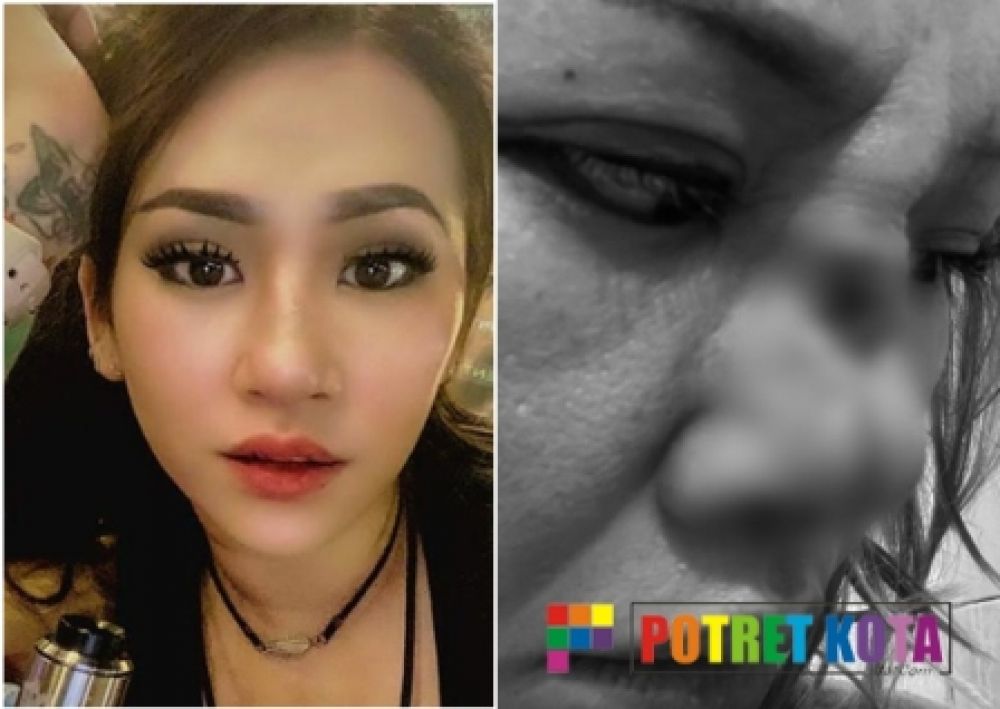 Fenny Febiany (kanan) setelah operasi hidung 
